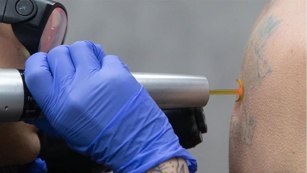 Removery Tattoo Removal & Fading By owner in Miami, Florida